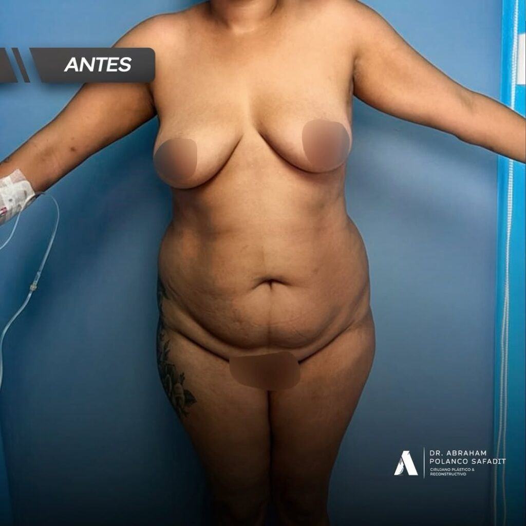 Antes de Cirugia Plastica con el Dr. Abraham Polanco Safadit